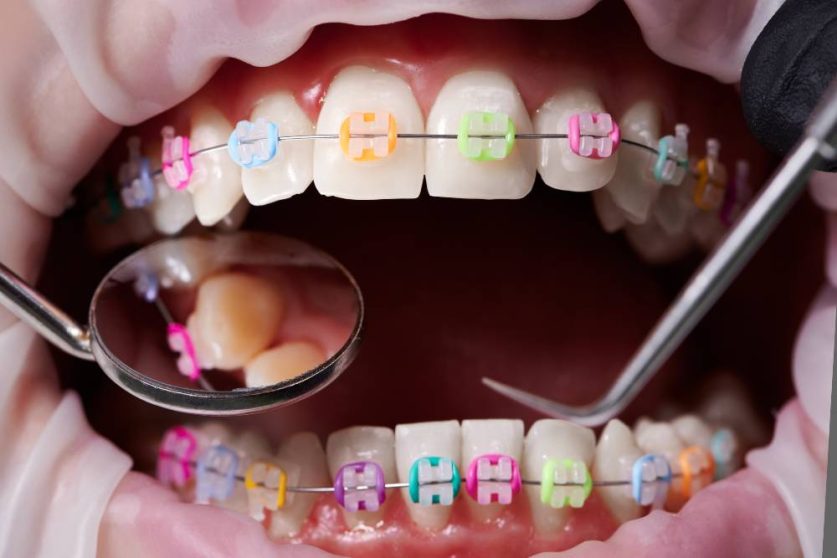 Dental braces colors