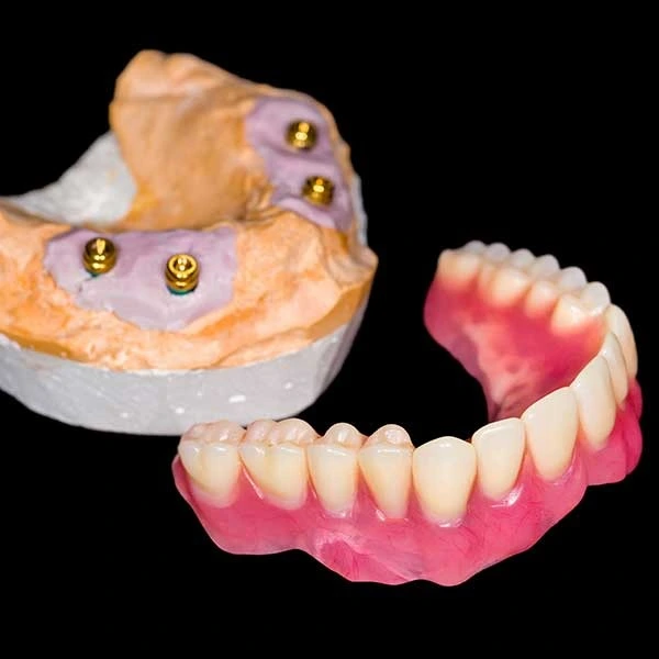 best full mouth dental implants